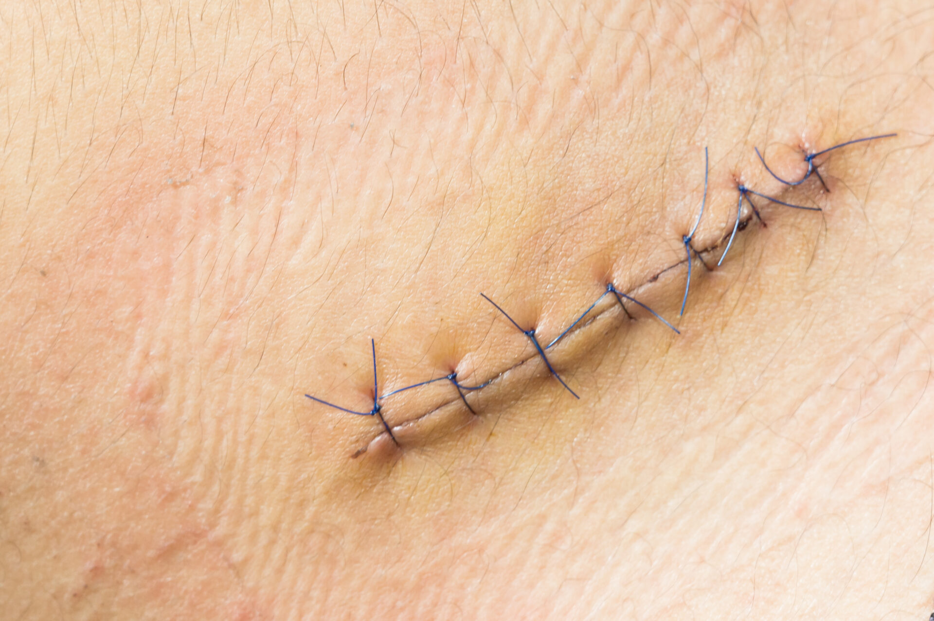 帝王切開の傷跡を縫合した様子