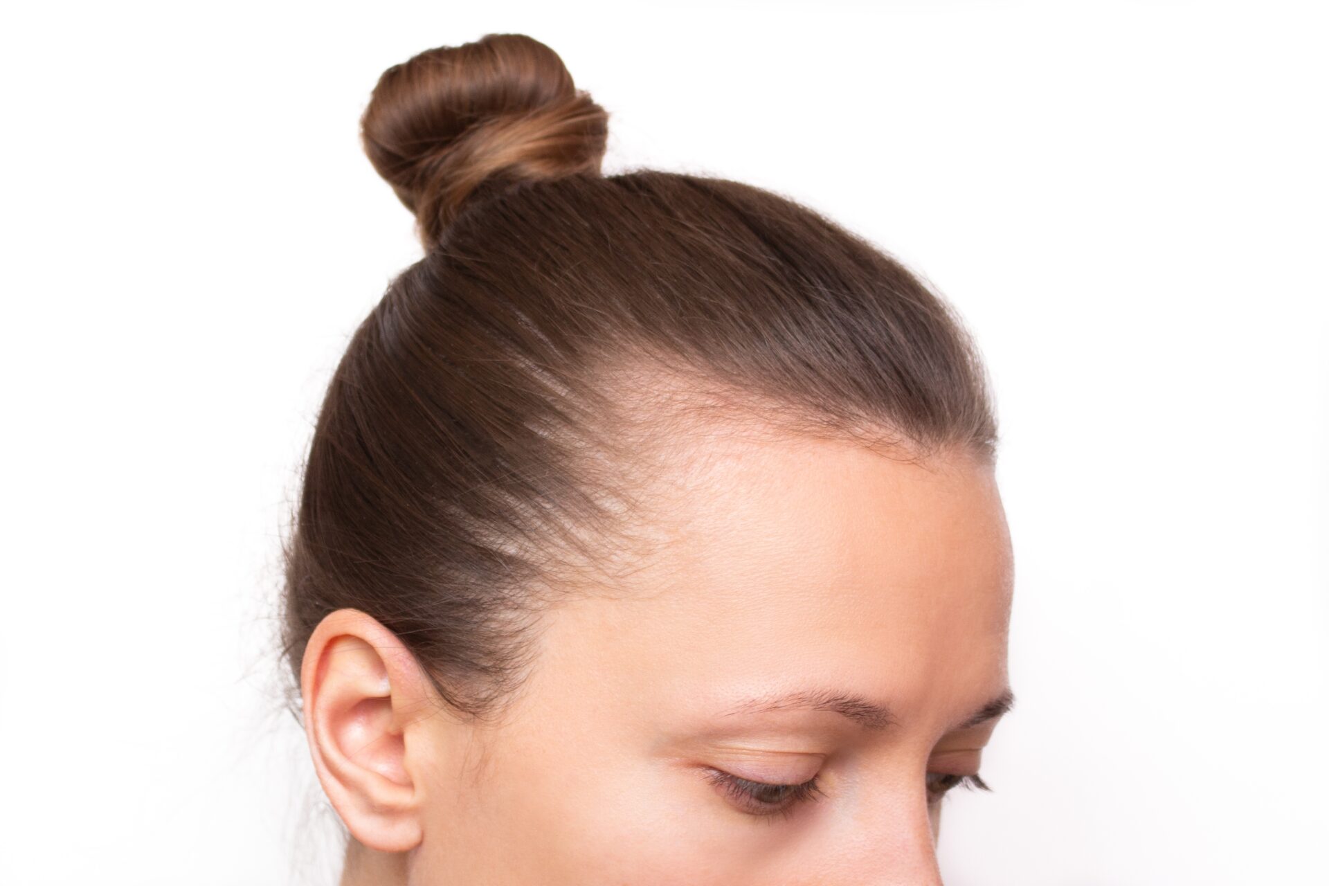 【こめかみ縮小術】広すぎるこめかみをスッキリ！顔のバランスを整える手術とは？