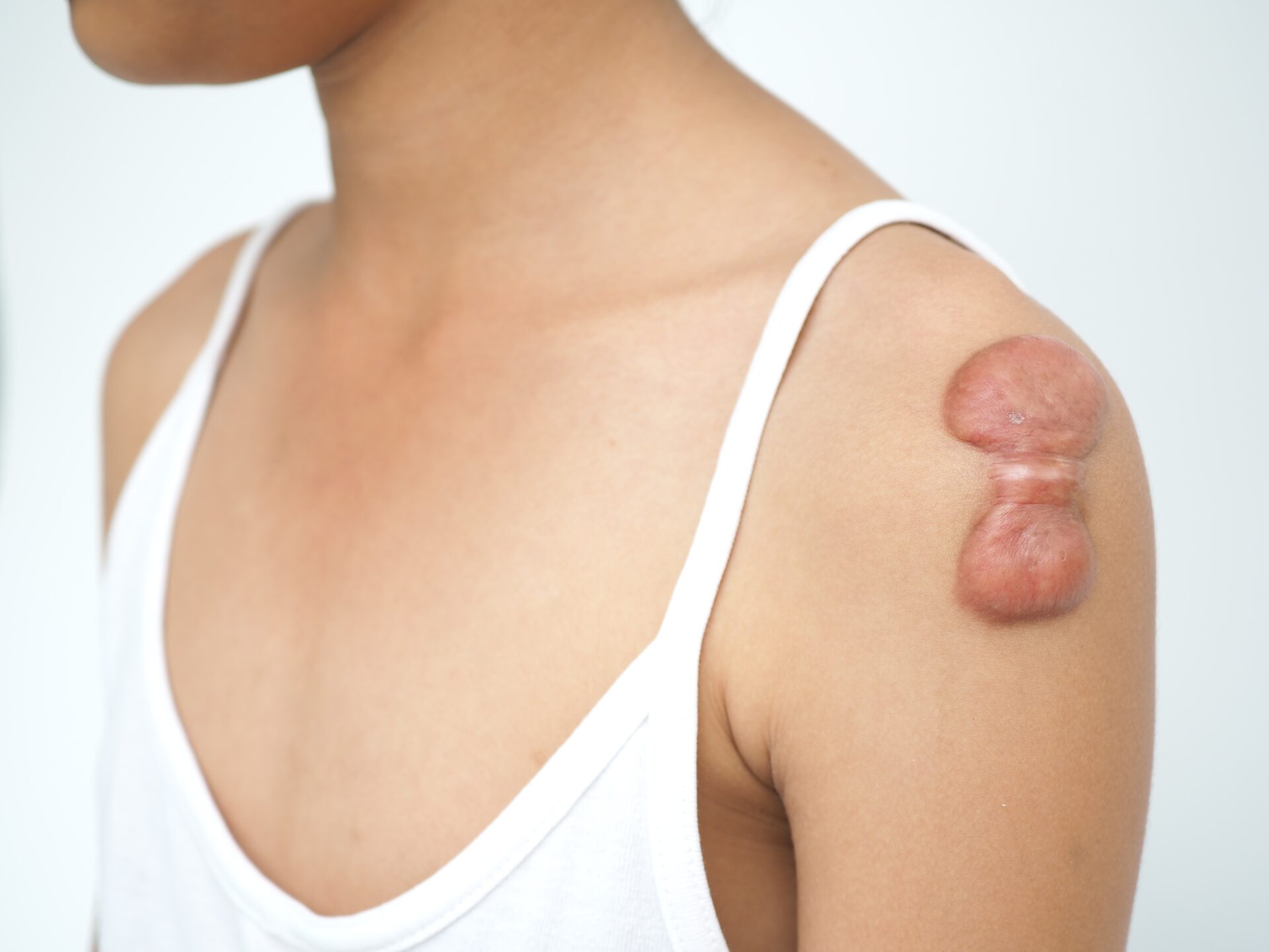 肩にケロイドが広がった女性