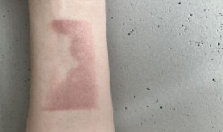 傷跡修正の施術