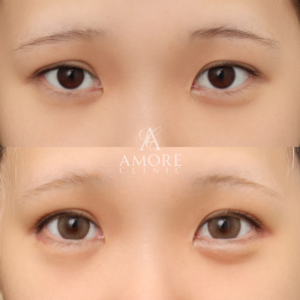 自然癒着法＋グラマラスライン形成