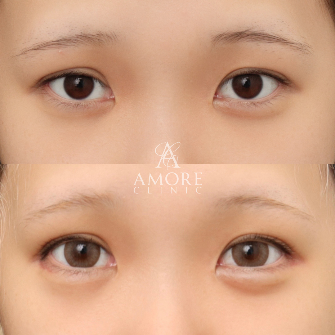 自然癒着法＋グラマラスライン形成