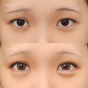 自然癒着法＋グラマラスライン形成