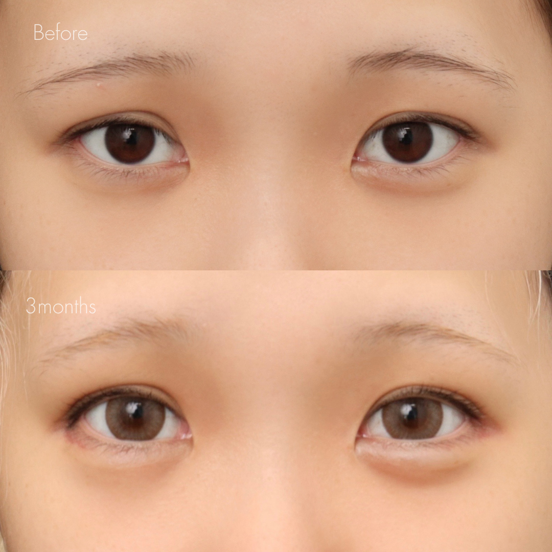 自然癒着法＋グラマラスライン形成