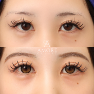 グラマラスライン形成