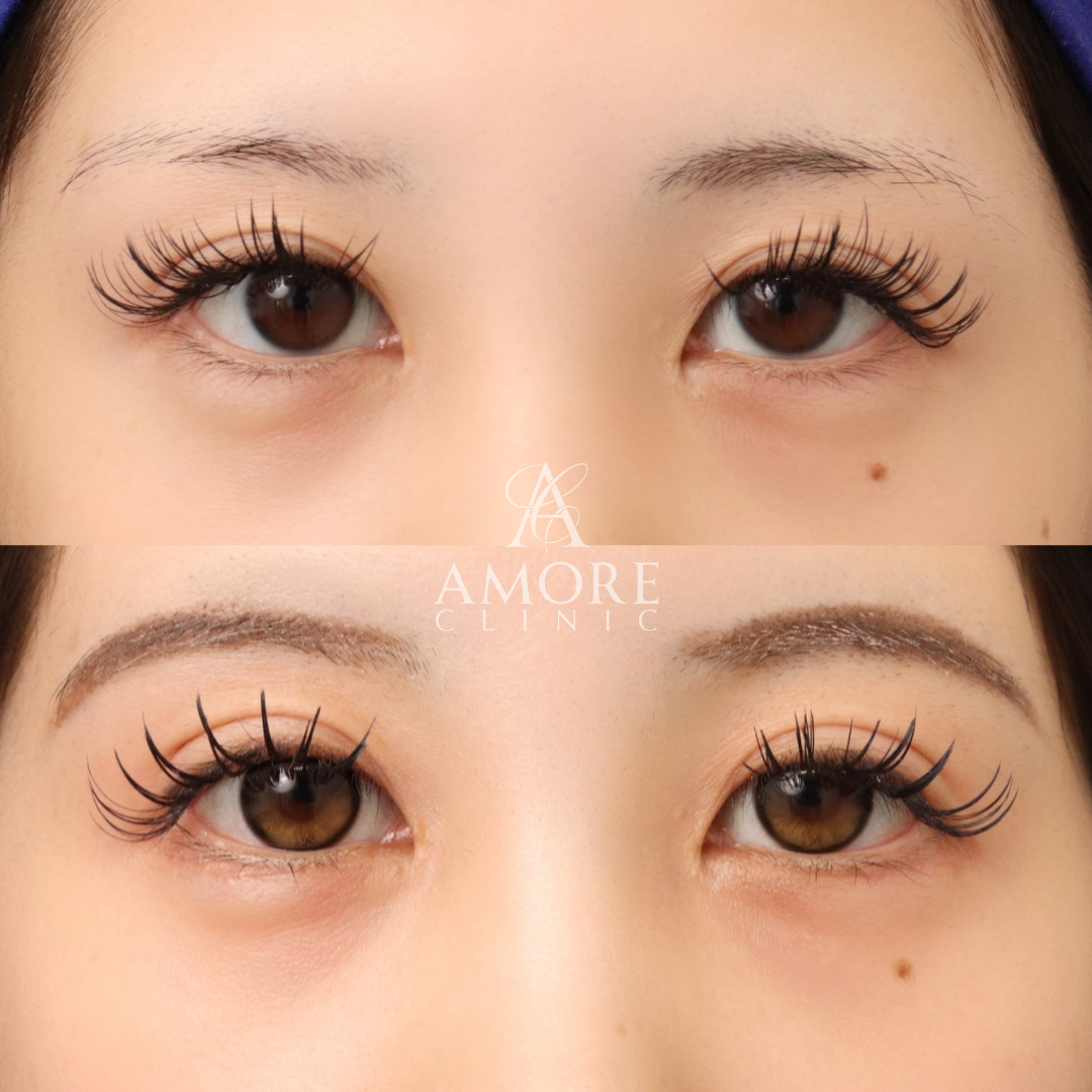 グラマラスライン形成