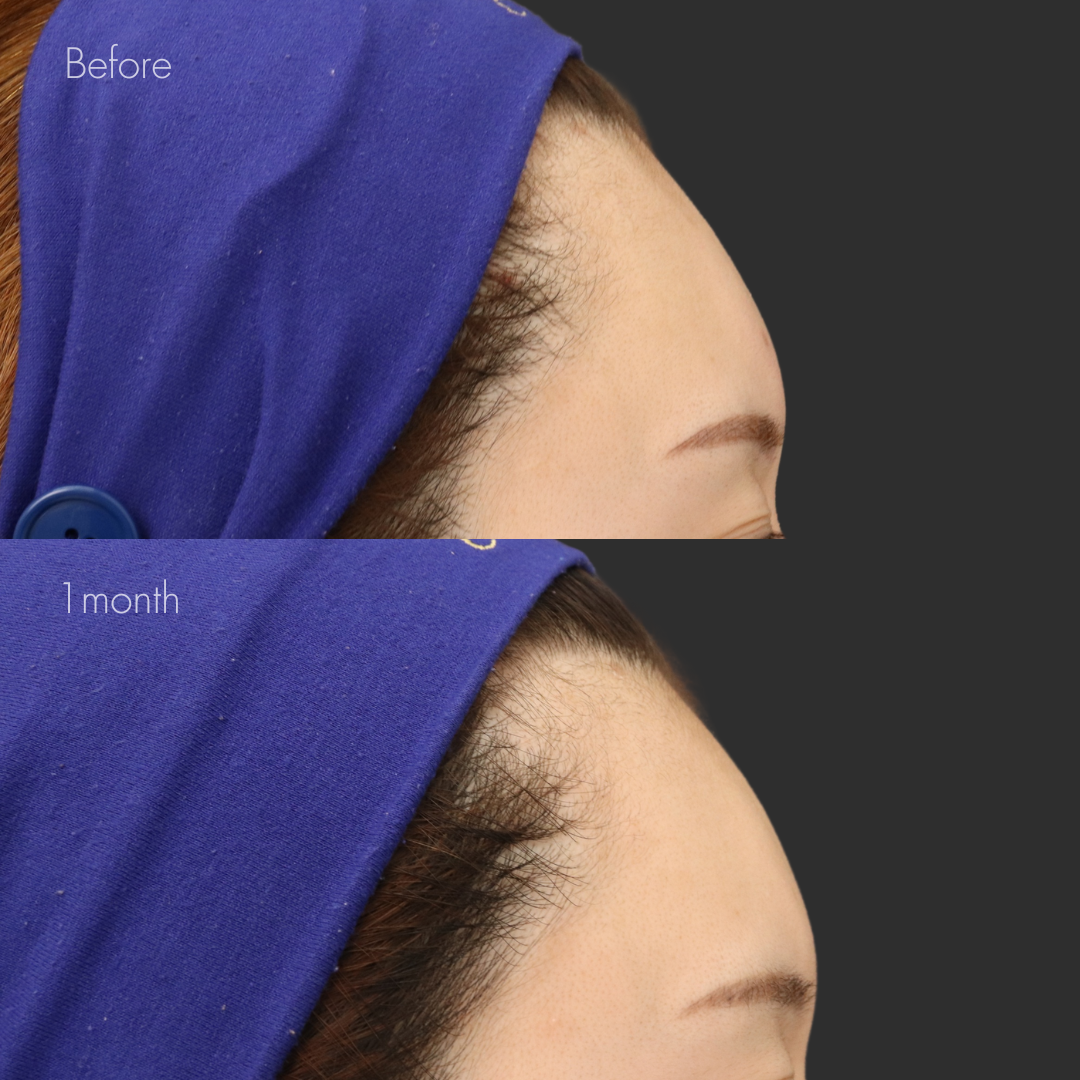 額ヒアルロン酸（ニューラミス3cc）