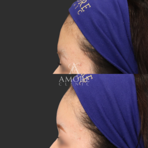 額ヒアルロン酸（ニューラミス5cc）