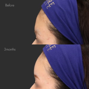 額ヒアルロン酸（ニューラミス5cc）