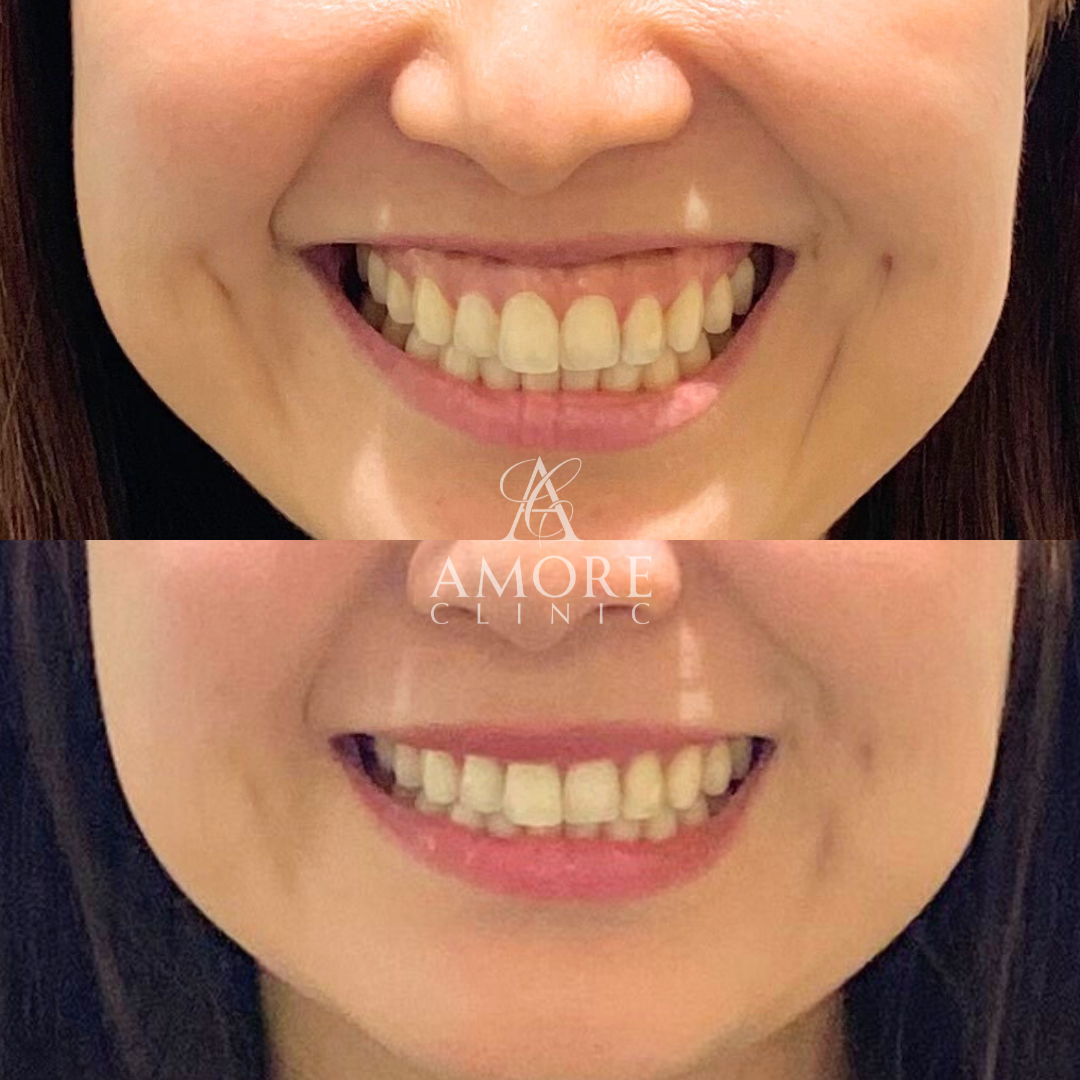 ガミースマイルボトックス