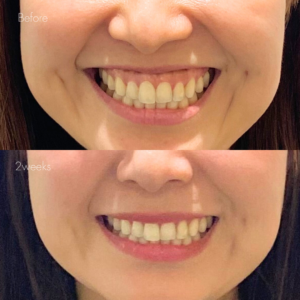 ガミースマイルボトックス