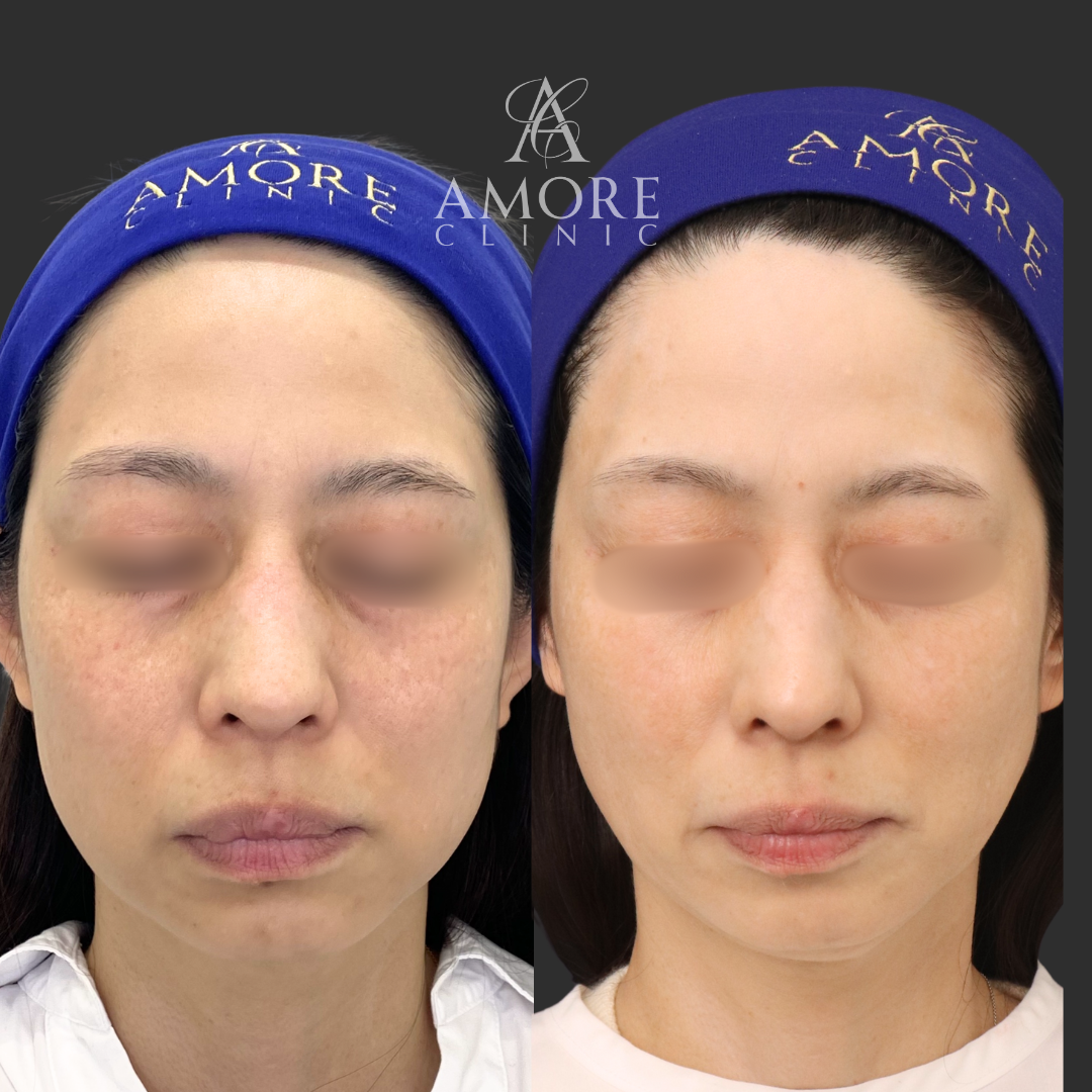 ピコトーニング＋ピコトーニング（10回コース）