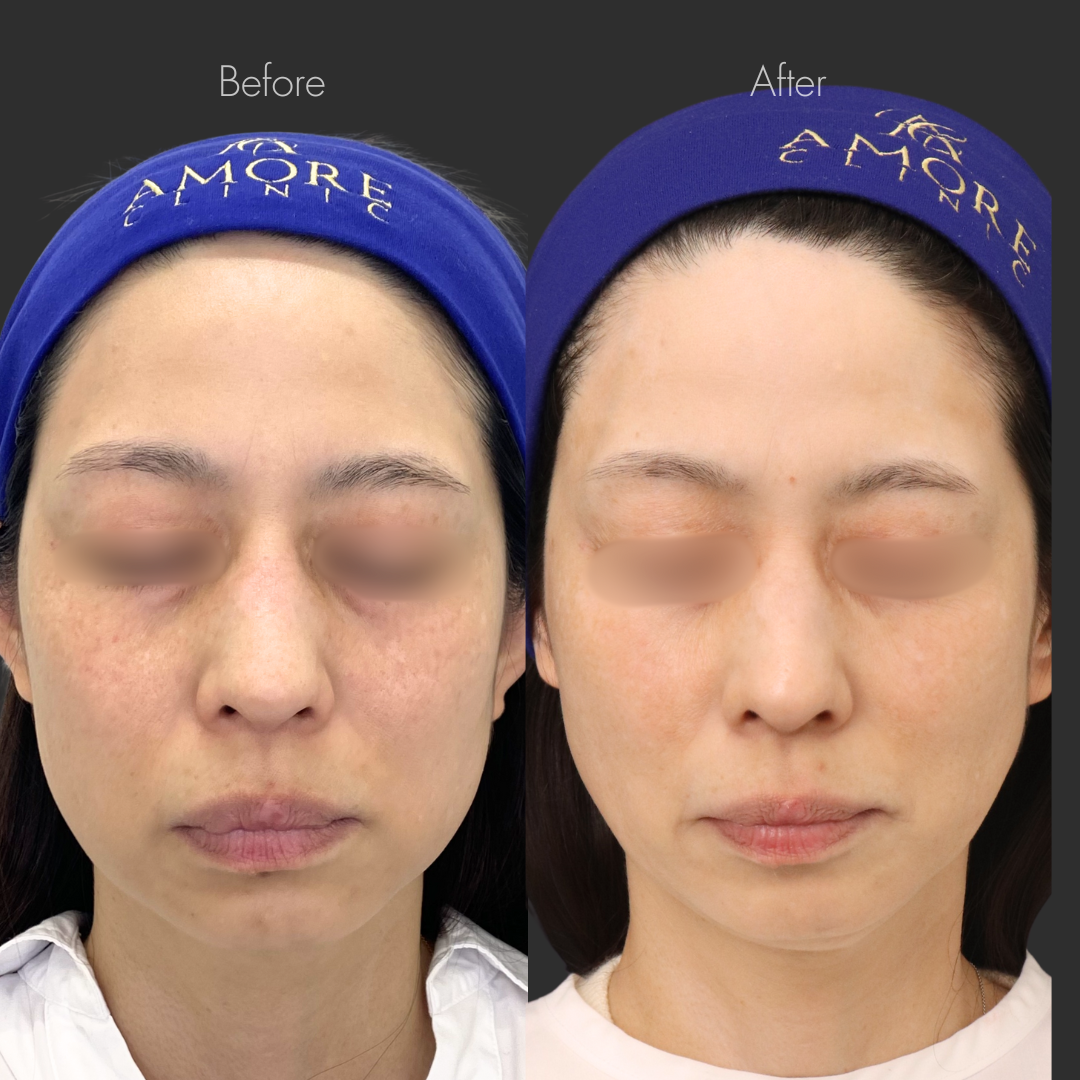 ピコトーニング＋ピコトーニング（10回コース）