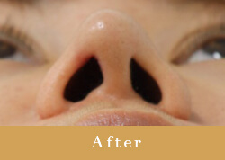 鼻尖整容（鼻先プロテーゼ）