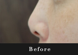 鼻尖整容（鼻先プロテーゼ）