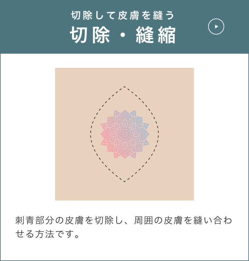 タトゥー・刺青レーザー除去
