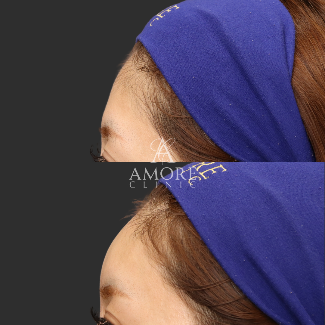 額ヒアルロン酸（ジュビダーム6cc）