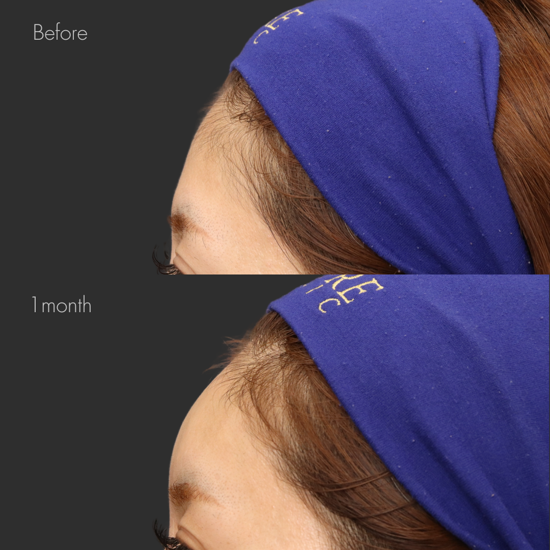 額ヒアルロン酸（ジュビダーム6cc）