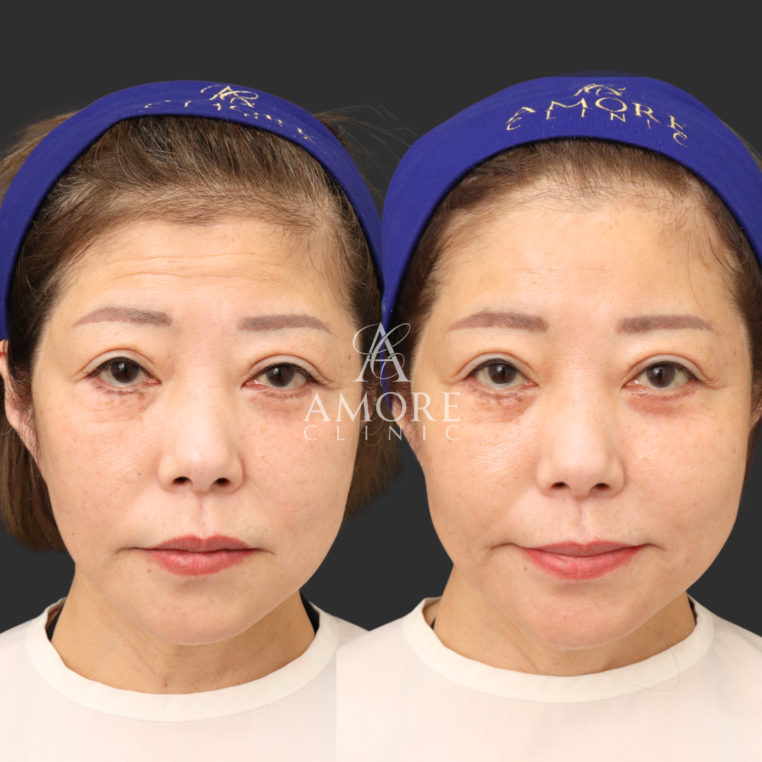 CRF脂肪注入（全顔）＋ネックリフト＋ペリカンリフト＋貴族リフト（8本）＋目の下たるみ取り＋下眼瞼脱脂＋ボトックス（額・眉間・鼻根）