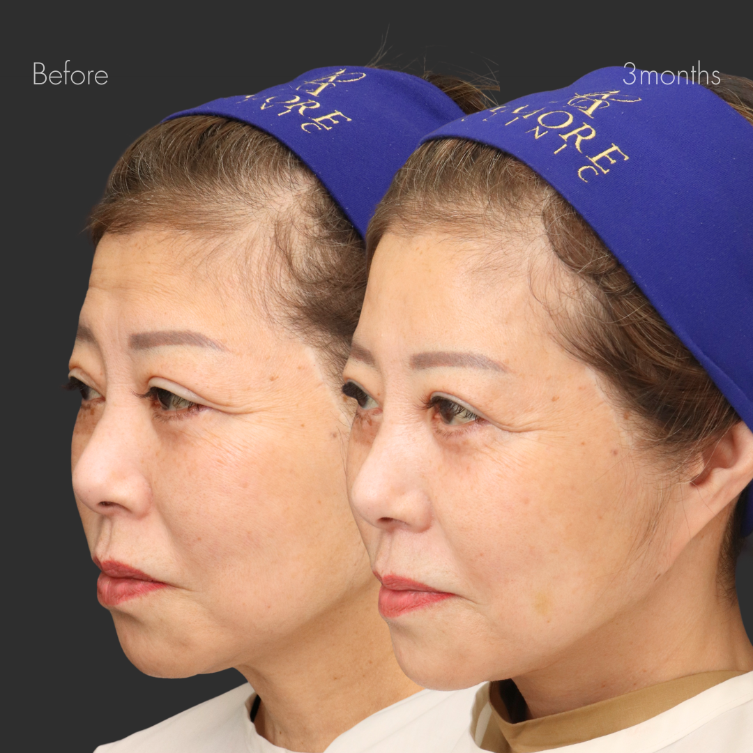 CRF脂肪注入（全顔）＋ネックリフト＋ペリカンリフト＋貴族リフト（8本）＋目の下たるみ取り＋下眼瞼脱脂＋ボトックス（額・眉間・鼻根）