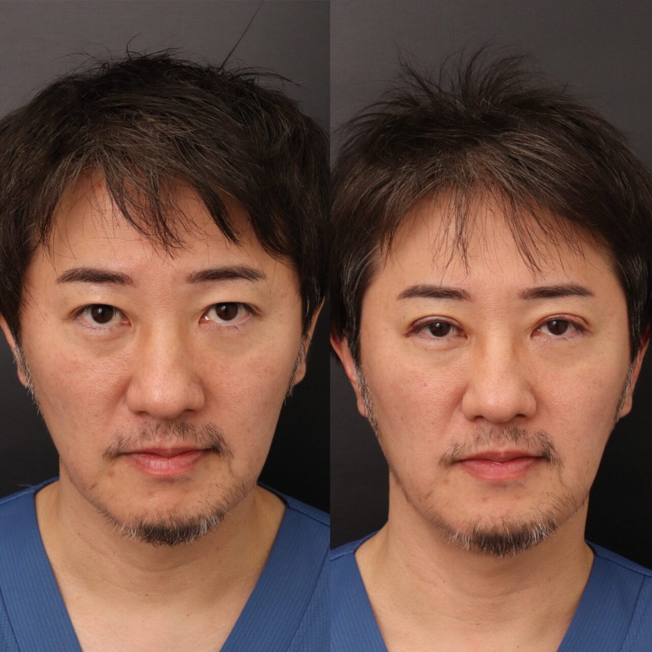 二重の手術を受けました