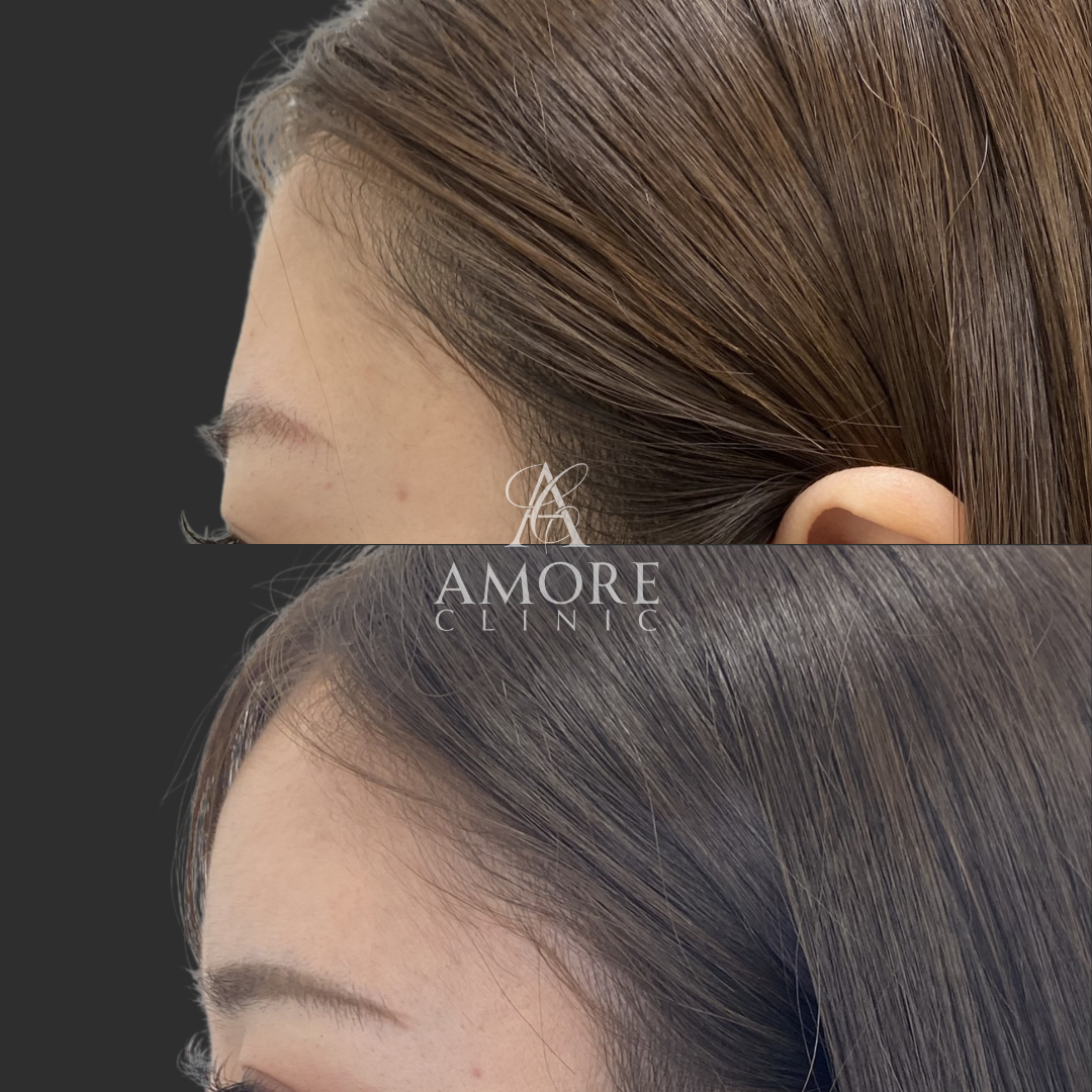 CRF脂肪注入（額）