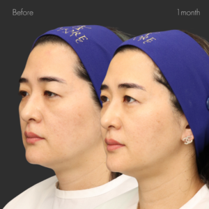 オーダーメイドヒアルリフト（ジュビダーム3㏄）