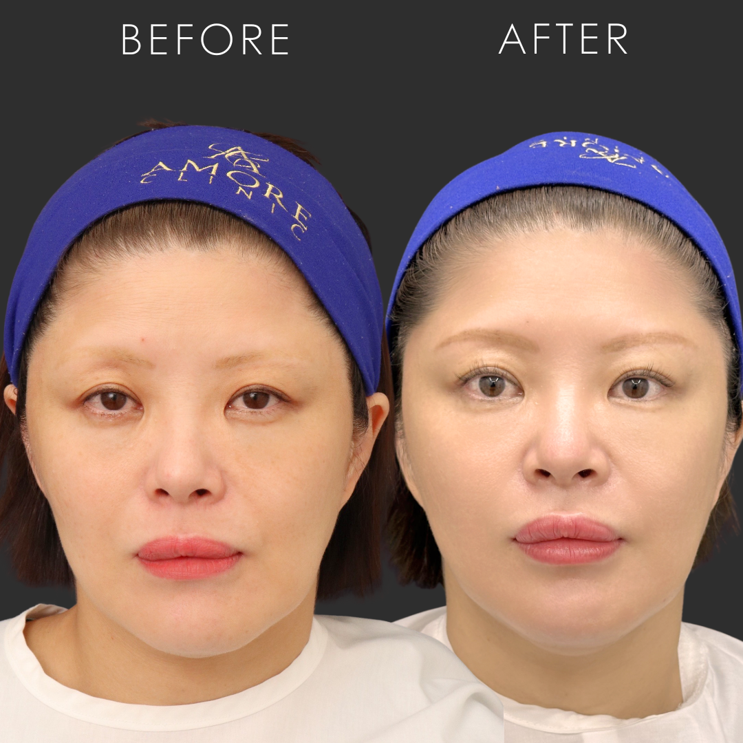 女性に人気のポニーテールリフト|目元から中顔面のたるみを自然に改善するリフトアップ施術