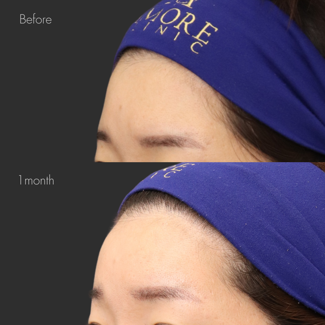 額ヒアルロン酸（ニューラミス7cc）