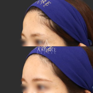 額ヒアルロン酸（ニューラミス3cc）