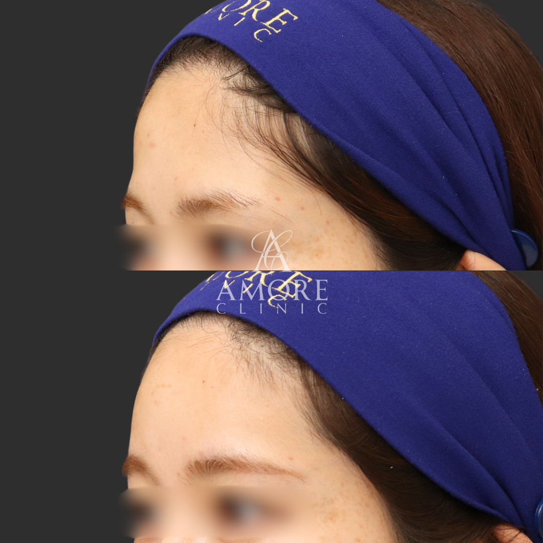 額ヒアルロン酸（ニューラミス3cc）