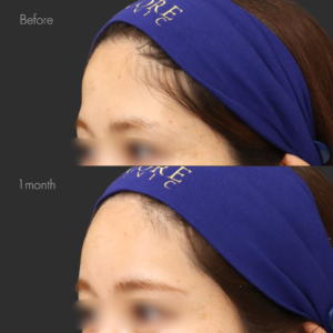 額ヒアルロン酸（ニューラミス3cc）