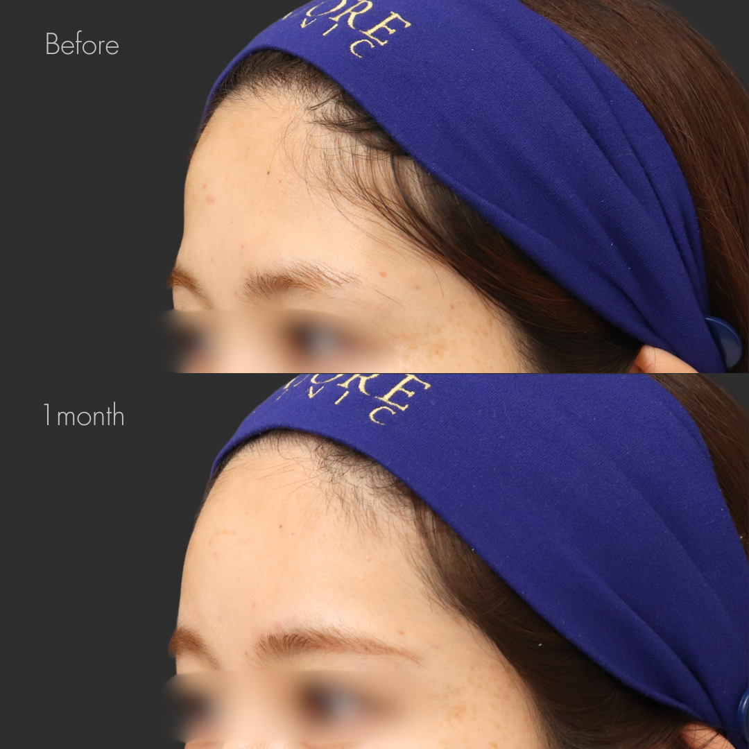 額ヒアルロン酸（ニューラミス3cc）