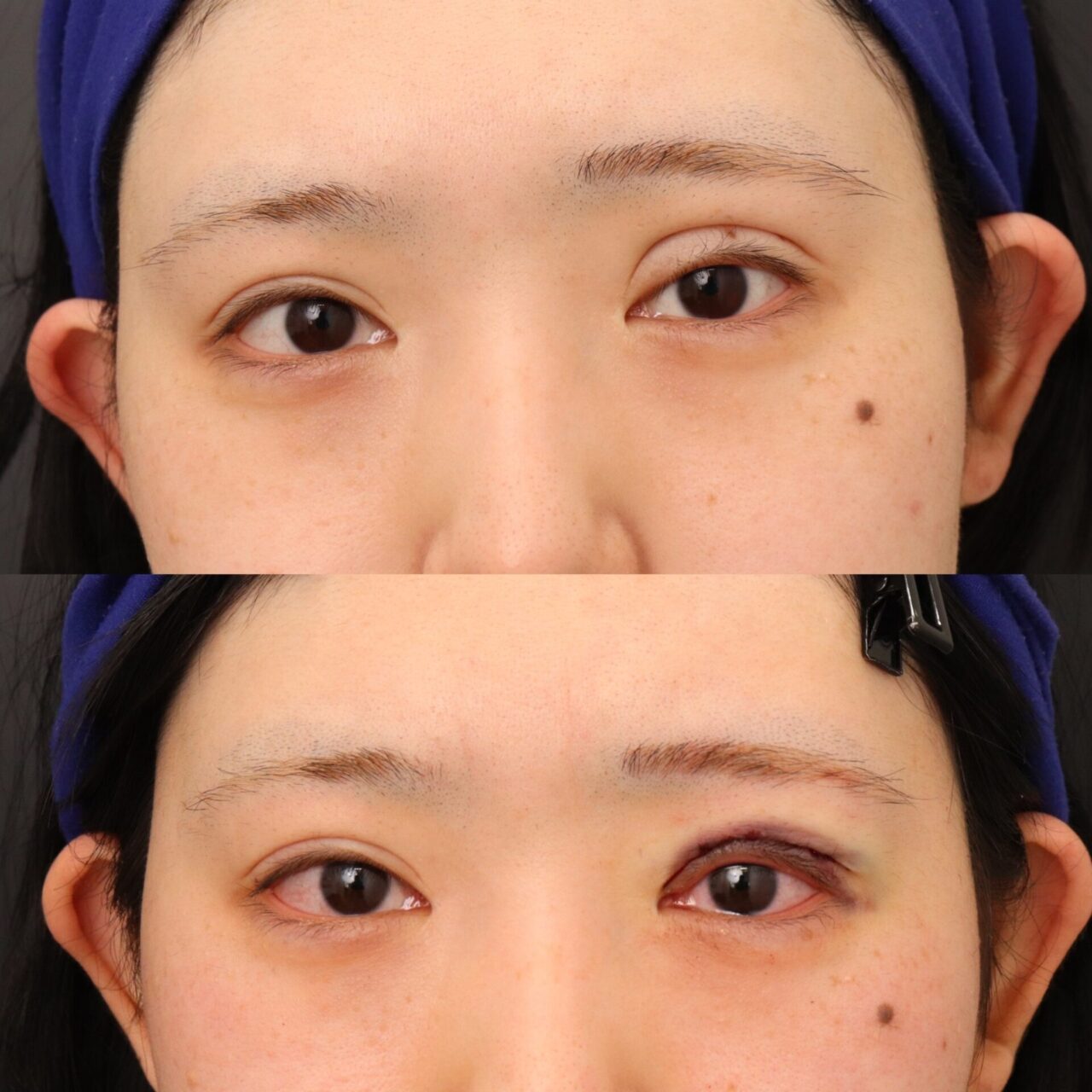 眼瞼下垂の修正手術を行いました