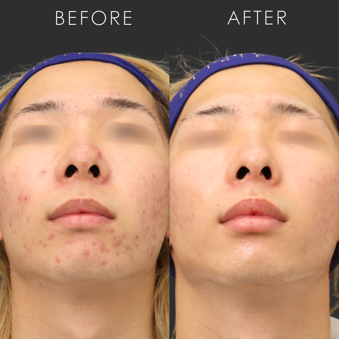 イソトレチノイン(ロアキュタン)の効果と副作用|ニキビ原因から治療例まで徹底解説