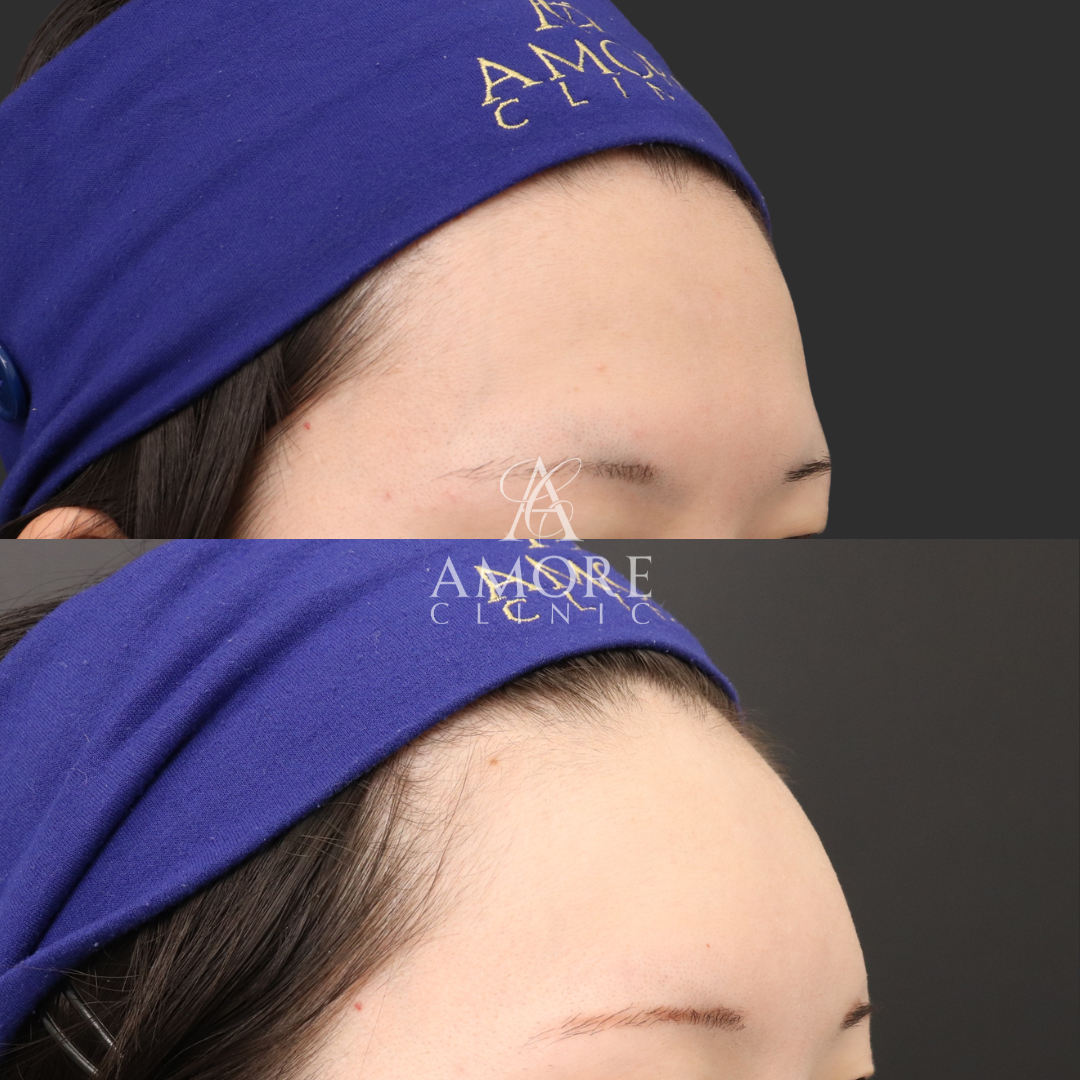 額ヒアルロン酸（ニューラミス5cc）