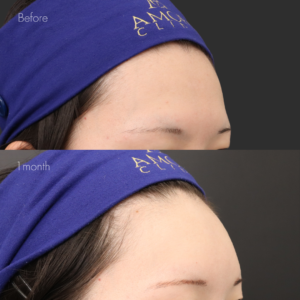 額ヒアルロン酸（ニューラミス5cc）