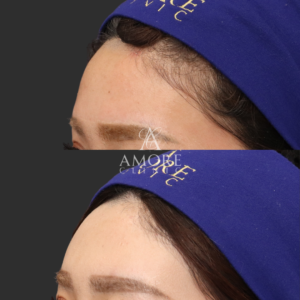 額ヒアルロン酸（ニューラミス2cc）