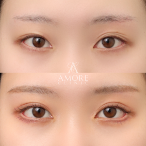 パーフェクト二重術（二重全切開＋たるみ除去＋脂肪除去）＋蒙古襞切除＋グラマラスライン形成