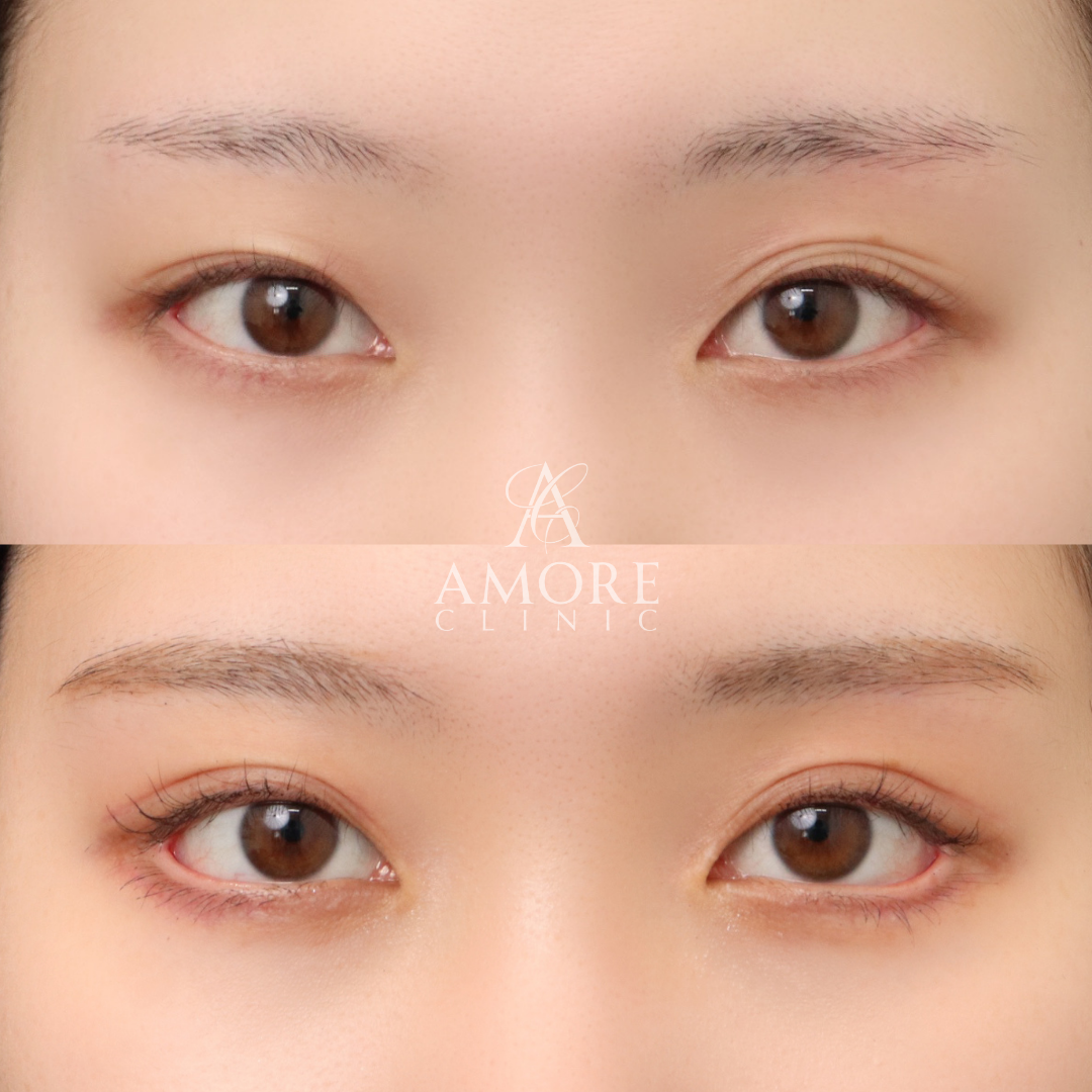 パーフェクト二重術（二重全切開＋たるみ除去＋脂肪除去）＋蒙古襞切除＋グラマラスライン形成