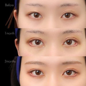 パーフェクト二重術（二重全切開＋たるみ除去＋脂肪除去）＋蒙古襞切除＋グラマラスライン形成