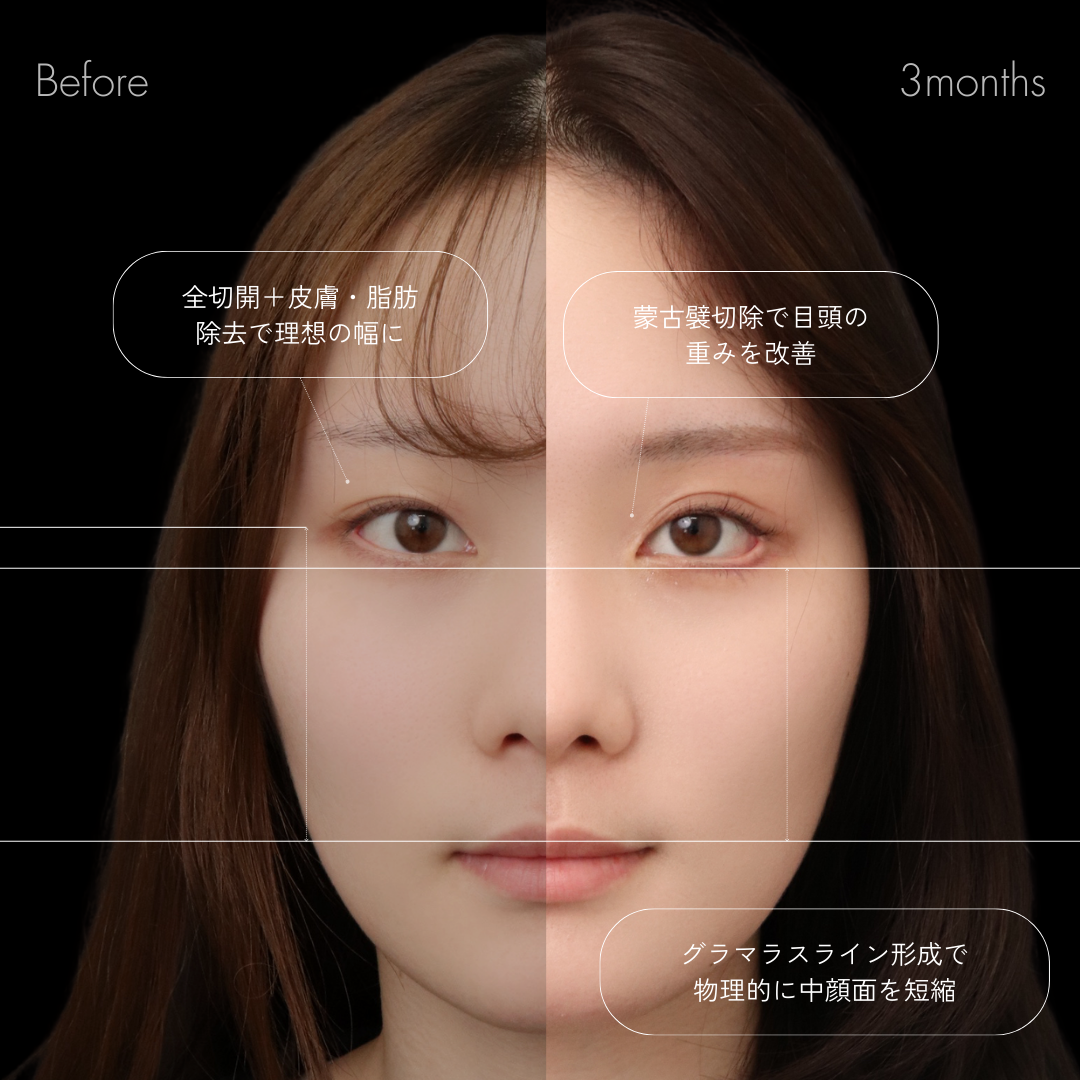 パーフェクト二重術（二重全切開＋たるみ除去＋脂肪除去）＋蒙古襞切除＋グラマラスライン形成