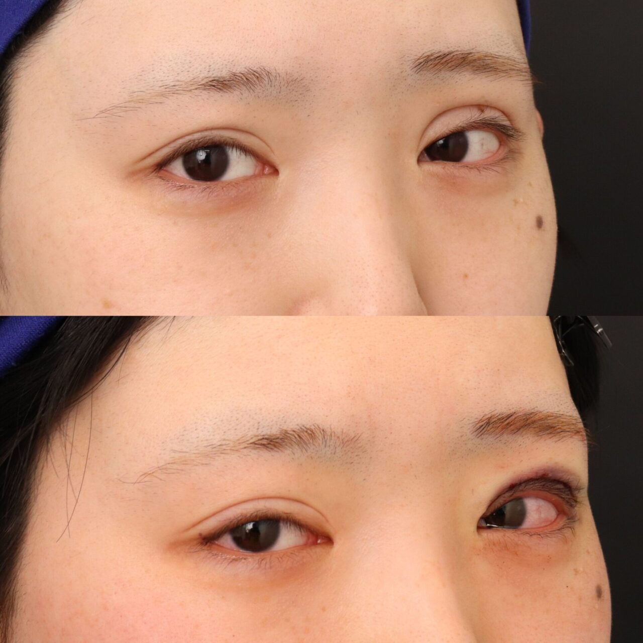 眼瞼下垂の修正手術を行いました