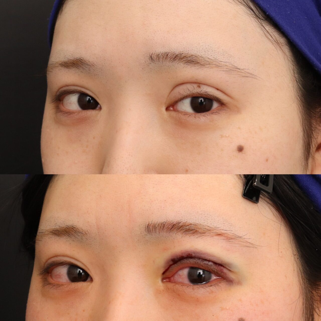 眼瞼下垂の修正手術を行いました