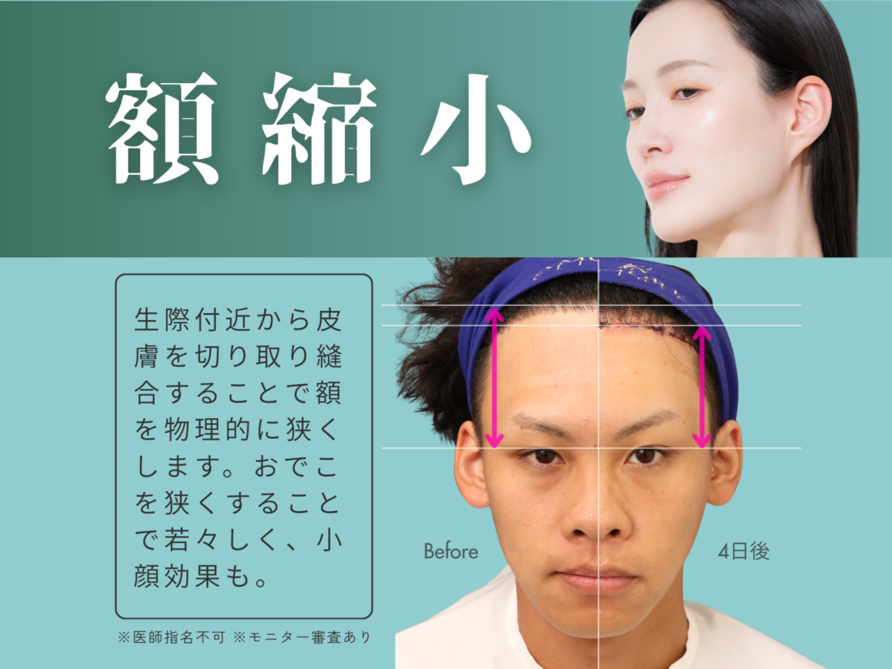 今月のイチオシ施術