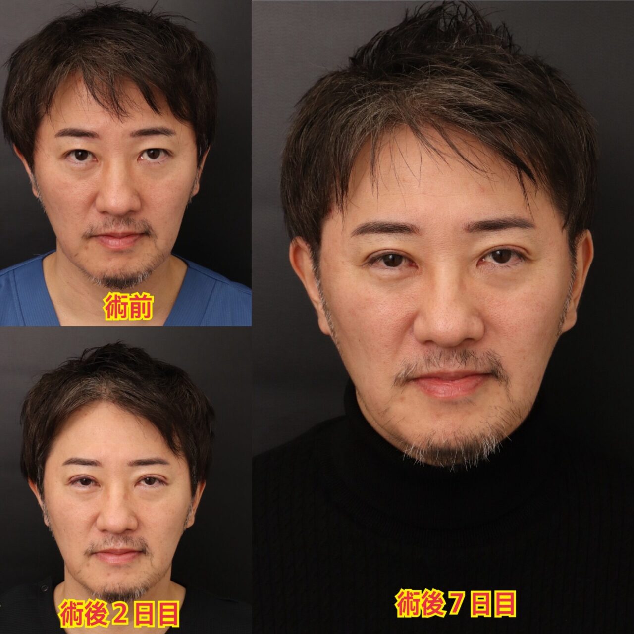 二重の手術を受けました