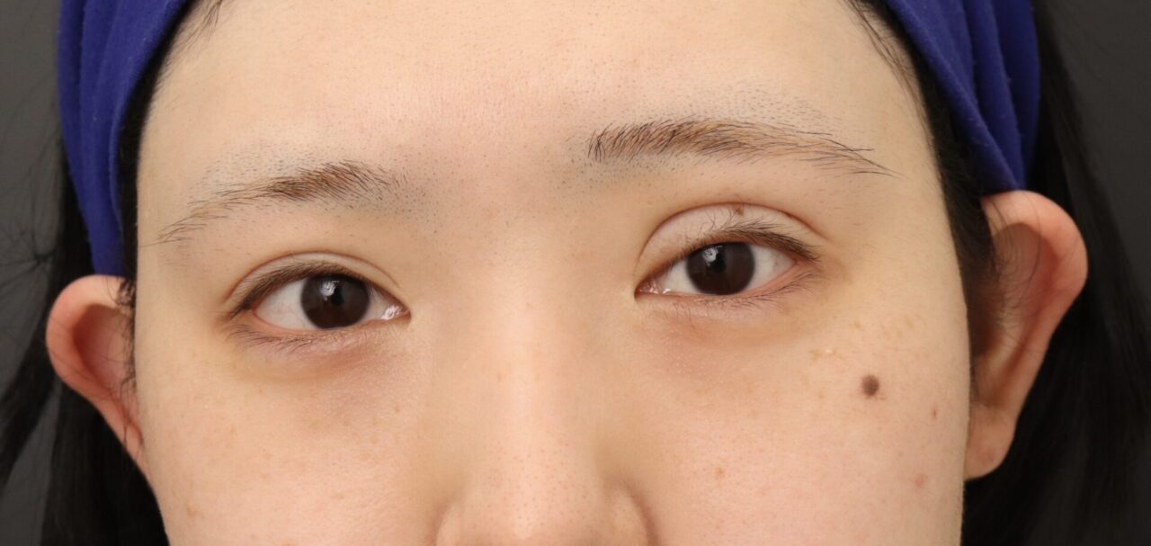 眼瞼下垂の修正手術を行いました