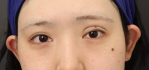 眼瞼下垂の修正手術を行いました