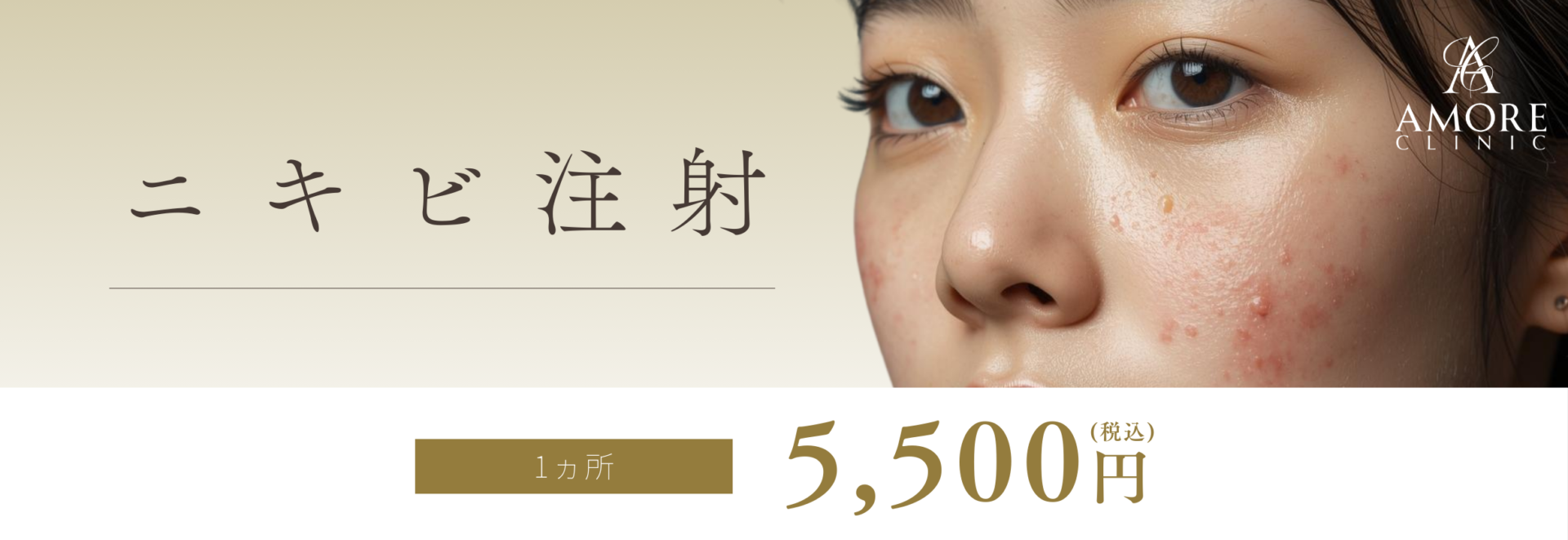 ニキビ注射