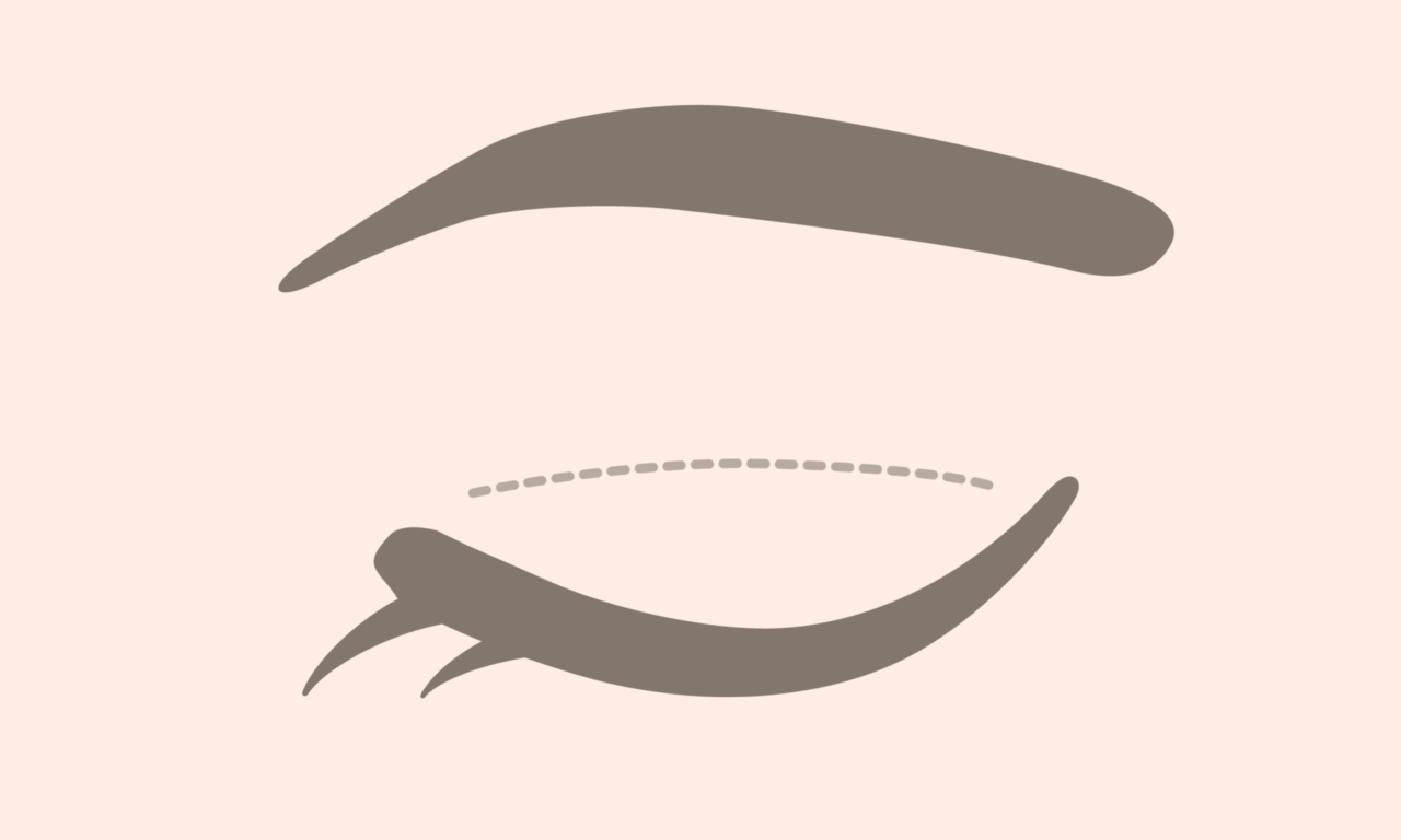 二重全切開・眼瞼下垂の修正